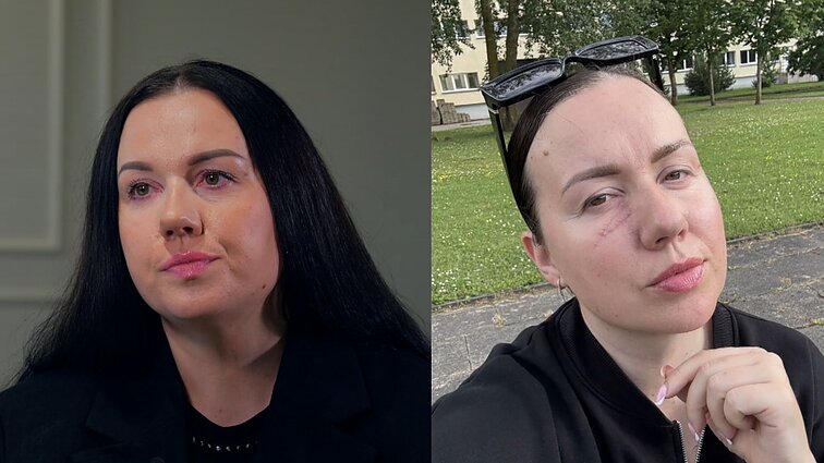 Iš JK į Lietuvą operuotis dėl odos vėžio grįžusi Justina: eilės pas gydytoją laukiau metus