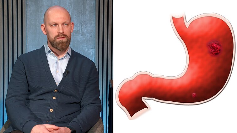 Dažnai jaučiate rėmenį? Gydytojas įspėja: tai – vienas iš skrandžio vėžio požymių