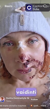 Redita Dominaitytė patyrė traumą Redita Dominaitytė patyrė traumą