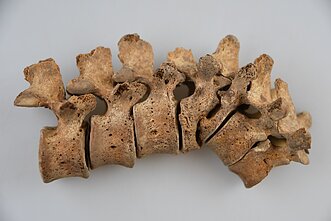 Tuberkuliozės pažeistas jauno vyro stuburas, Subačiaus g. 7 Tuberkuliozės pažeistas jauno vyro stuburas, Subačiaus g. 7
